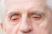 Sleep issues or Alzheimers